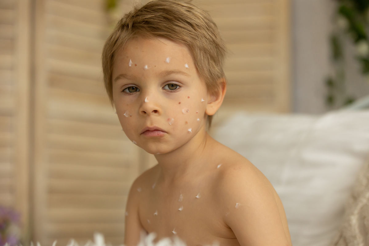 Ветрянка (ветряная оспа) у детей